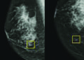 Google AI could improve breast cancer detection