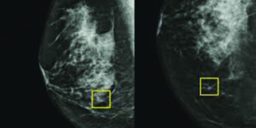 Google AI could improve breast cancer detection