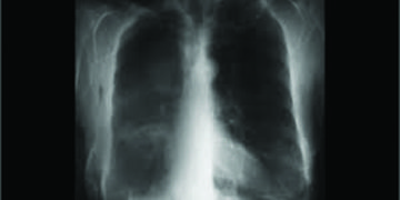 New study links vaping, lung disease