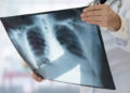  India treats ‘Missing Million’ TB cases; gap reduced to 3.5 lakh patients: Health Ministry