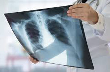  India treats ‘Missing Million’ TB cases; gap reduced to 3.5 lakh patients: Health Ministry