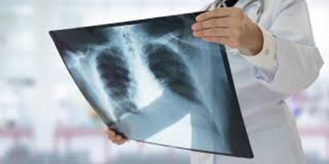  India treats ‘Missing Million’ TB cases; gap reduced to 3.5 lakh patients: Health Ministry