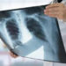  India treats ‘Missing Million’ TB cases; gap reduced to 3.5 lakh patients: Health Ministry