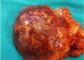 Navi Mumbai doctors remove rare tumour from left adrenal of senior citizen