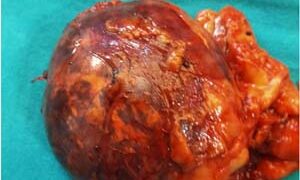Navi Mumbai doctors remove rare tumour from left adrenal of senior citizen