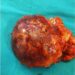 Navi Mumbai doctors remove rare tumour from left adrenal of senior citizen