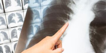 COVID clinical symptoms, CT scans or X-rays should be used to rule out false negatives: Experts