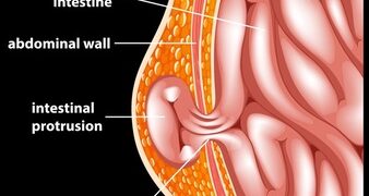 Hernia Risk Factors & Its Prevention