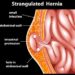 Hernia Risk Factors & Its Prevention