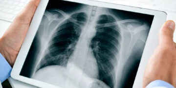 Artificial intelligence-based X-Ray Setu plans to on-board 10K docs for COVID detection in rural areas
