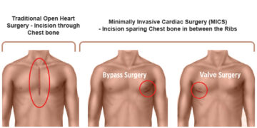 Specialized keyhole surgeries and improved lifestyle changes can lead to a healthy heart and a happy life
