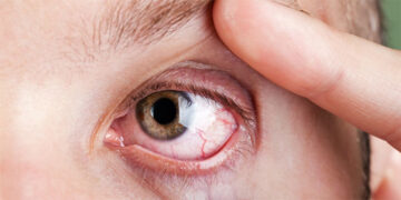 ZEISS helps Ahmedabad ophthalmologists in fight against increasing diabetic retinopathy cases