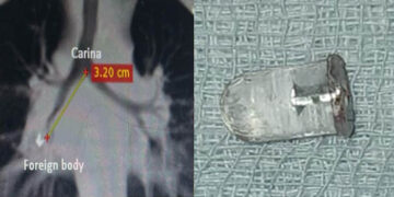Sri Ramachandra Hospital removes led bulb from kid’s lungs through bronchoscopy