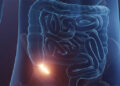 A silent threat: Understanding appendix cancer and its different stages