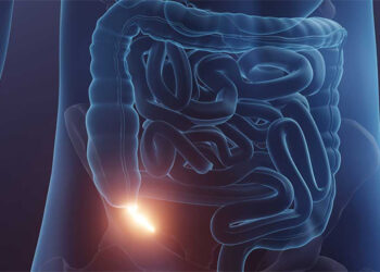 A silent threat: Understanding appendix cancer and its different stages