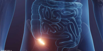 A silent threat: Understanding appendix cancer and its different stages